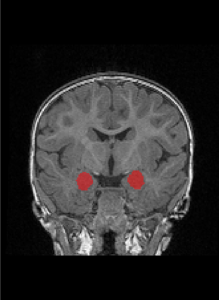 Black and white image of the amygdala in the color red.
