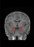 Black and white image of the amygdala in the color red.