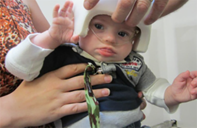 Baby Noah wearing oxygen and a helmet.